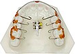 Upper dental model showing a removable orthodontic appliance with metal springs and clasps on the molars.